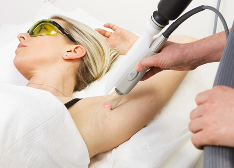 Laser Hair Removal Wirral